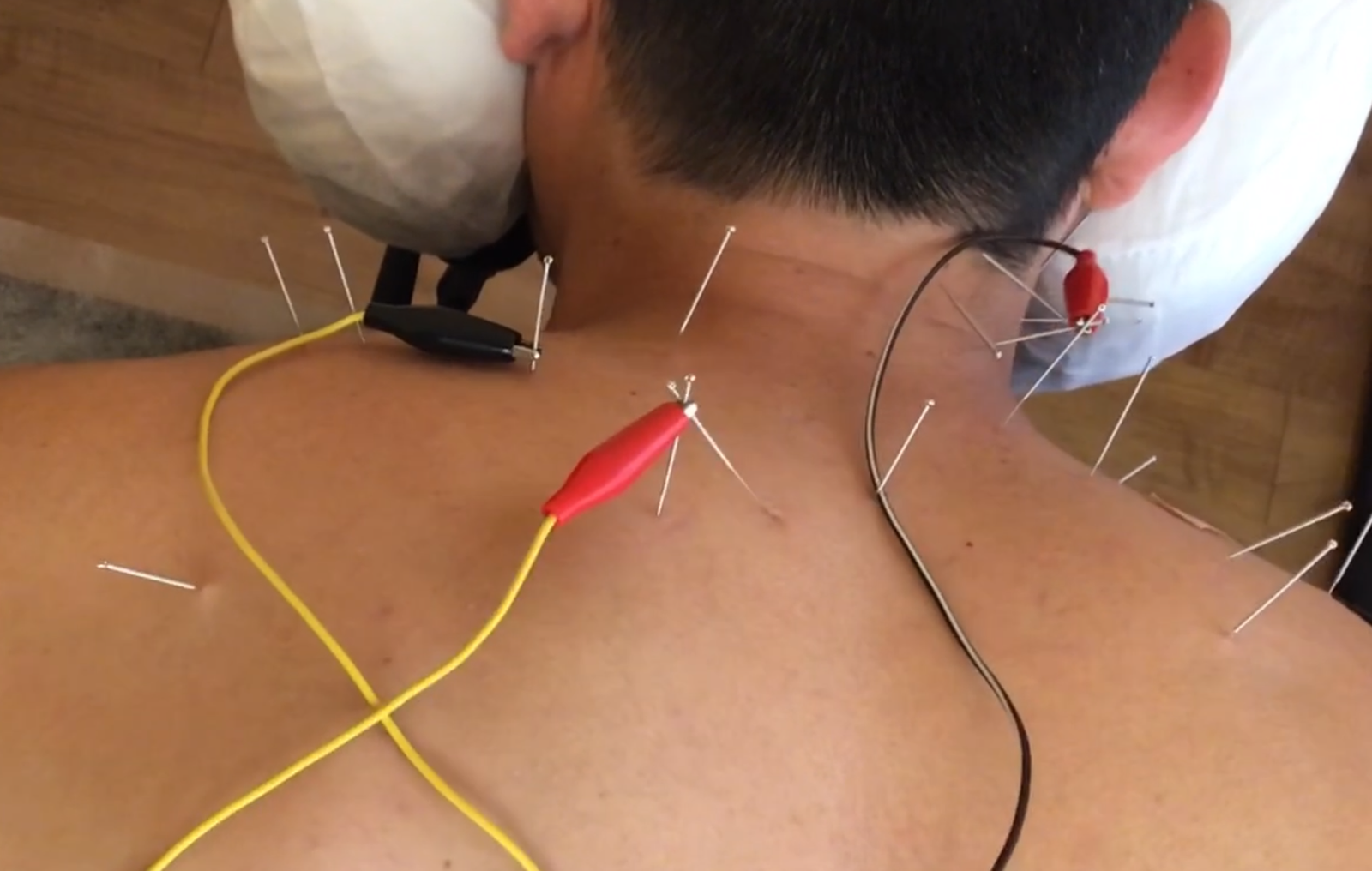 Advanced Dry Needling at the clinic